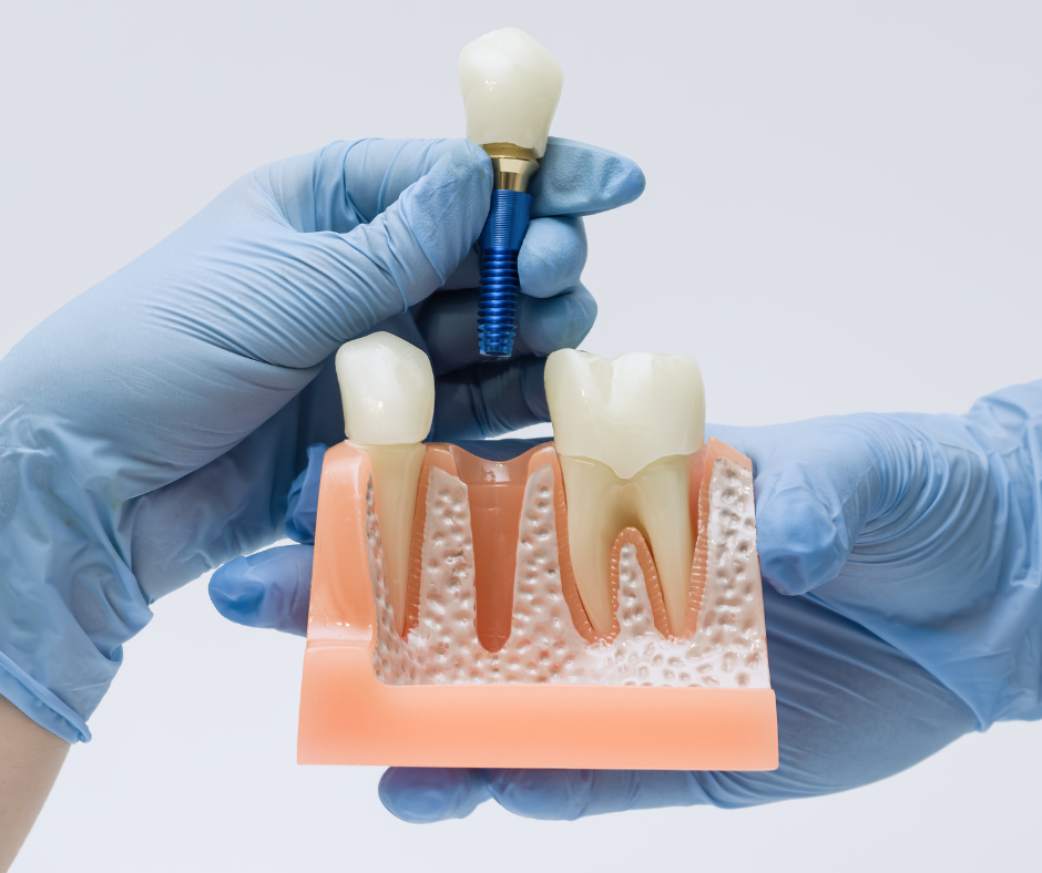 Implantología dental