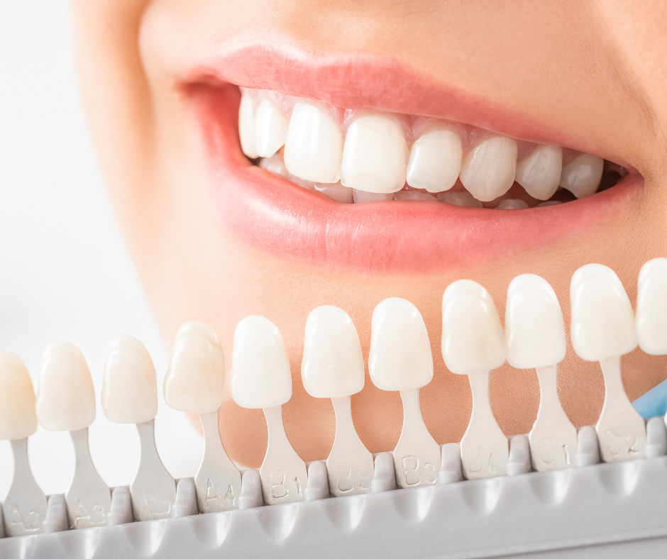 Estética dental y blanqueamiento