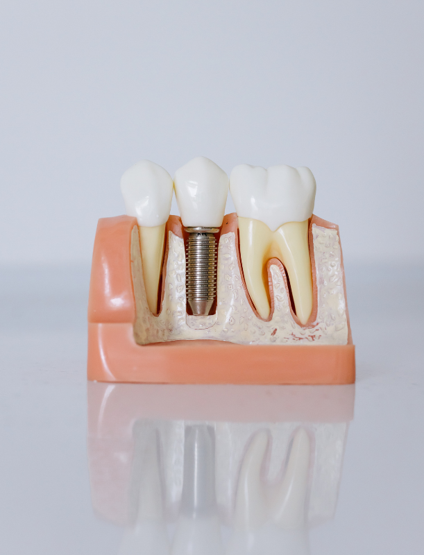 implantología dental